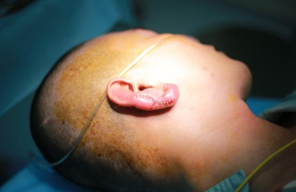 ▲ 베트남 현지 언론 투사오닷브엔는 18일 호찌민시 한 피부과 병원을 찾은 M씨의 사연을 전했다. M(24)씨는 귓불의 심한 통증으로 피부과 병원을 찾았는데, 의사는 “귓불이 괴사되었다”는 진단을 내렸다./자료사진